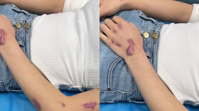 女性手部疤痕疙瘩疤痕修复 仪器治疗-竖屏