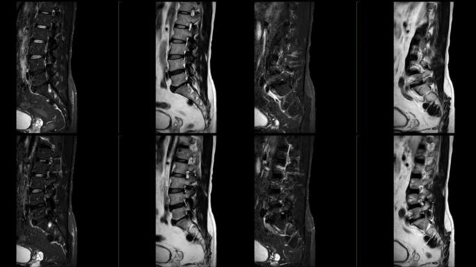 MRI L-S脊柱或腰椎矢状位T2W、FS和T2W。