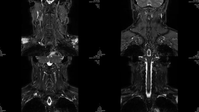 磁共振成像(MRI)