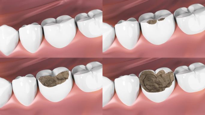 牙齿龋齿牙洞