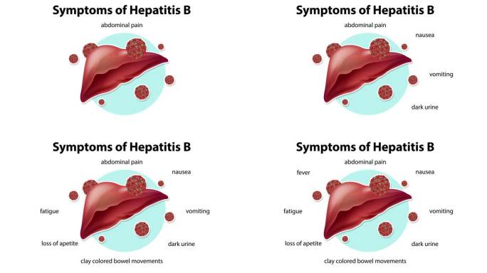 乙型肝炎动画的症状