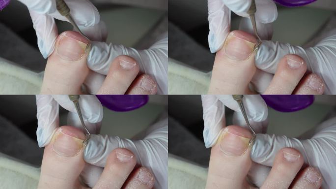 足疗专家用刮刀去除脚趾上的老茧