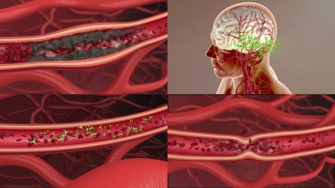 打通血栓  药物治疗 血管堵塞 血液细胞