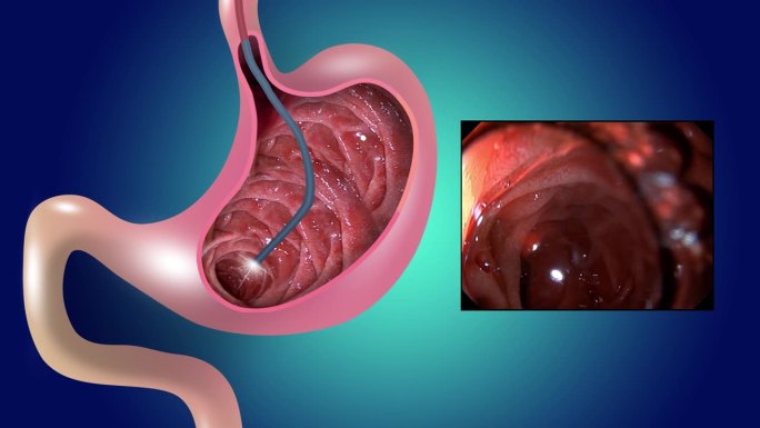 二维动画。胃粘膜。消化内窥镜或胃镜检查。进行胃镜检查。胃疾病的诊断。胃的健康。医学的概念