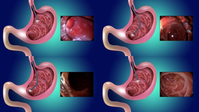 二维动画。胃粘膜。消化内窥镜或胃镜检查。进行胃镜检查。胃疾病的诊断。胃的健康。医学的概念