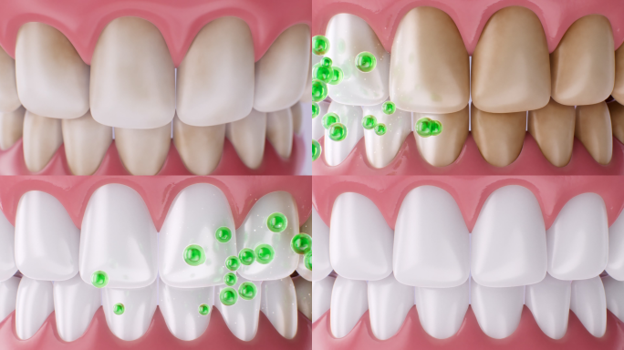 牙齿 变黄 牙垢 清洁