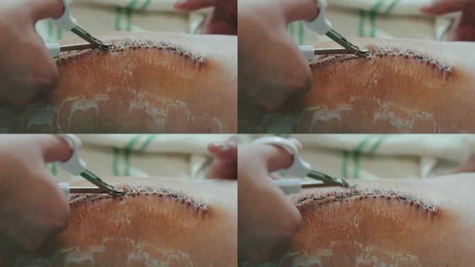 医生给手术缝合伤口拆线