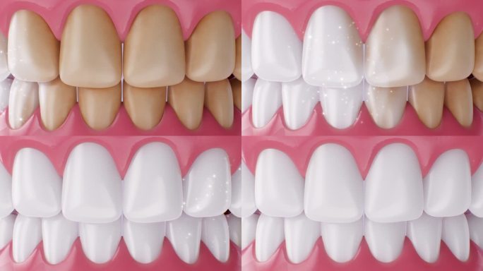 牙齿亮白
