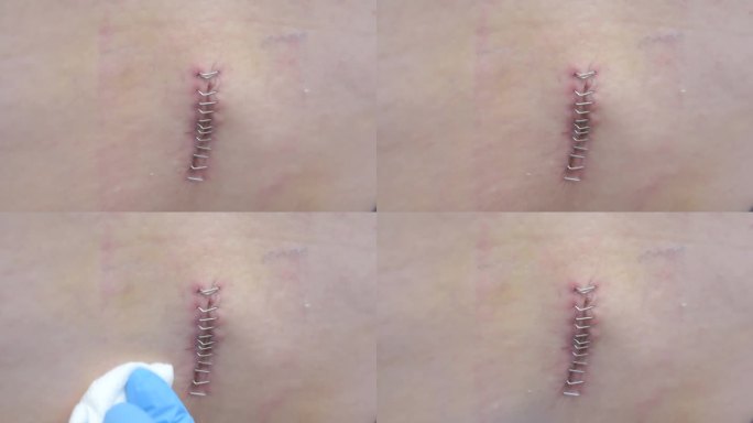 一名戴着手套的医疗工作者小心地清洁一个用钉子固定的闭合手术切口，突显了术后护理和卫生实践。