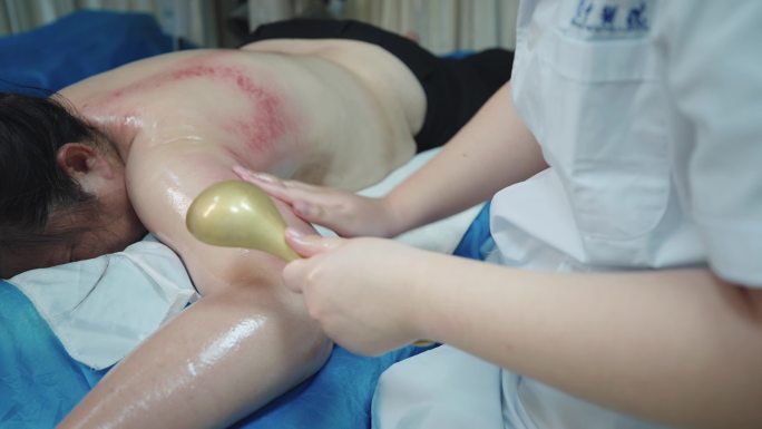中医 养身 治病 医院 刮痧