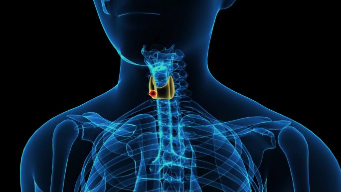 甲状腺癌 肿瘤 甲状腺健康