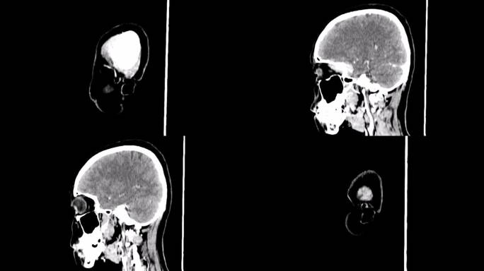 蝶翼脑膜瘤，CT扫描