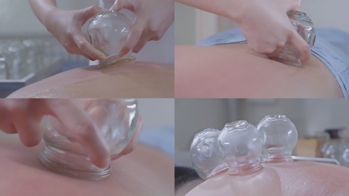 中医火罐