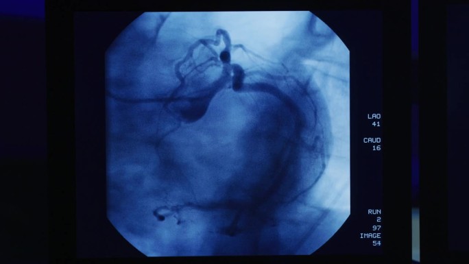 具有心导管检查程序的计算机监视器;插入导管以清除动脉阻塞。