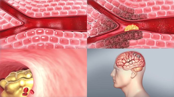保护心脑康复 畅通血管 血液循环血管堵塞