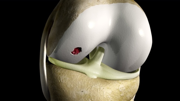 膝关节膝盖软骨磨损与损伤