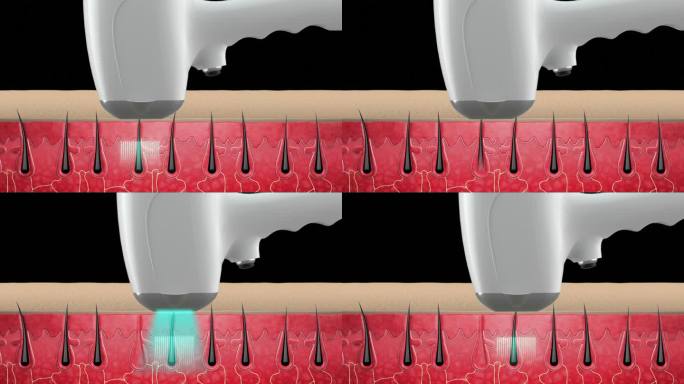毛囊，激光除毛，头发修护，C4D工程文件