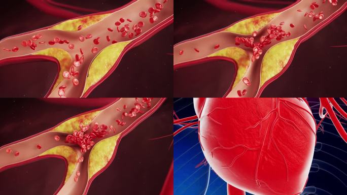 心脏血管堵塞，血栓形成，心肌梗死