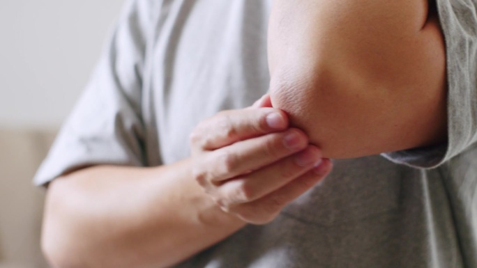 特写:男子用手抓挠发痒的肘部，伴有红疹。保健和医学概念。湿疹皮肤