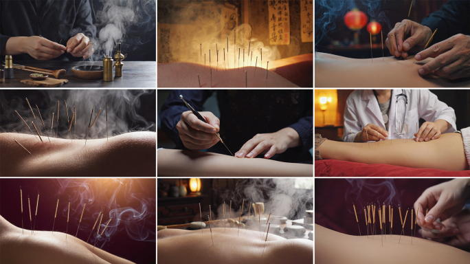 针灸 中医针灸疗 传统中医针灸