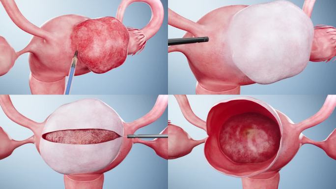 子宫肌瘤切除手术演示，女性妇科疾病