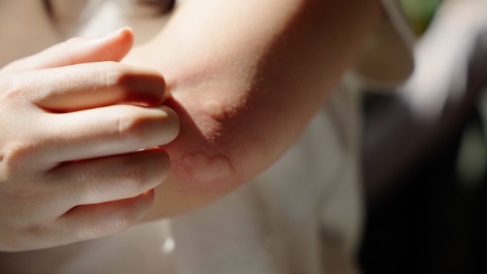 蚊子叮咬皮肤起包抓痒