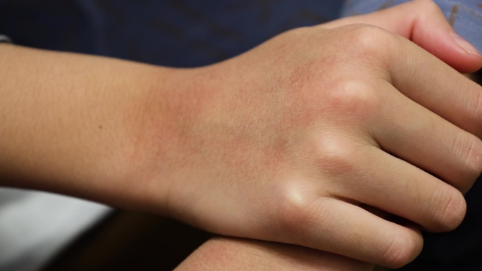 儿童皮肤干燥发红红疹护手霜冻伤