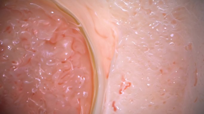 肠镜 肠镜检查影像  肠道内部影像